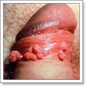 остроконечные кондиломы полового члена